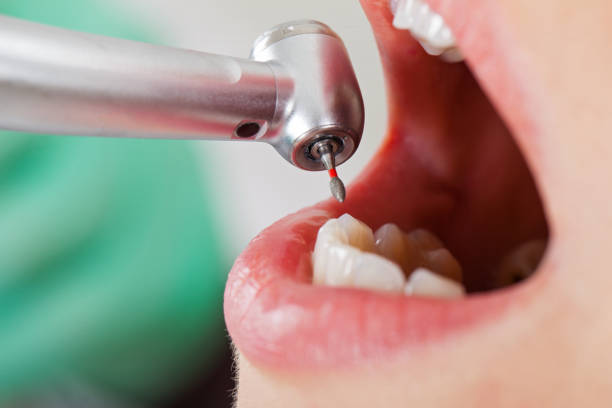Best Emergency Treatment for Dental Infections or Abscesses in Carencro, LA